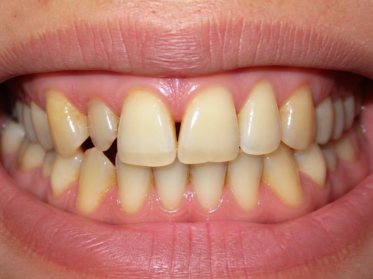 Patient teeth before dental treatment
